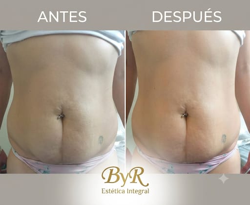 Antes y después cintura
